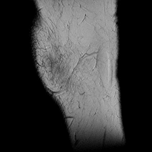 Right Knee MRI - Side View