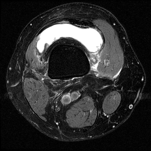 Right Knee MRI - Top View
