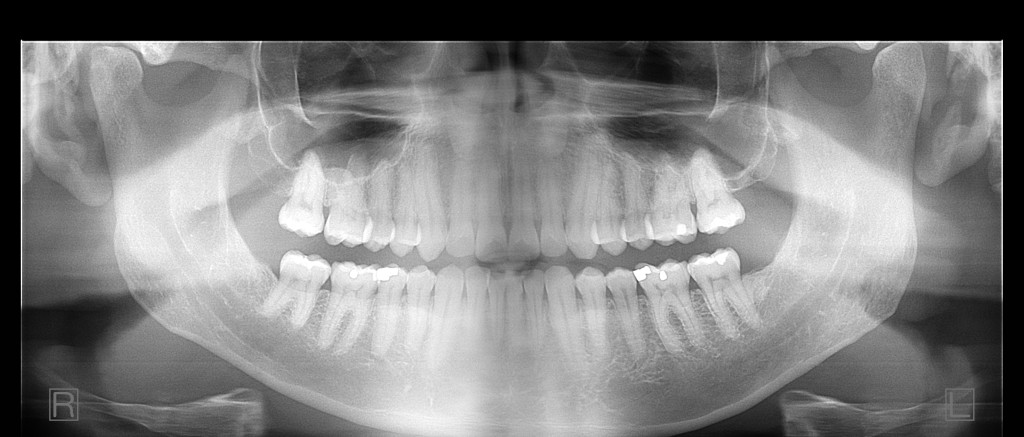 Panoramic Radiograph
